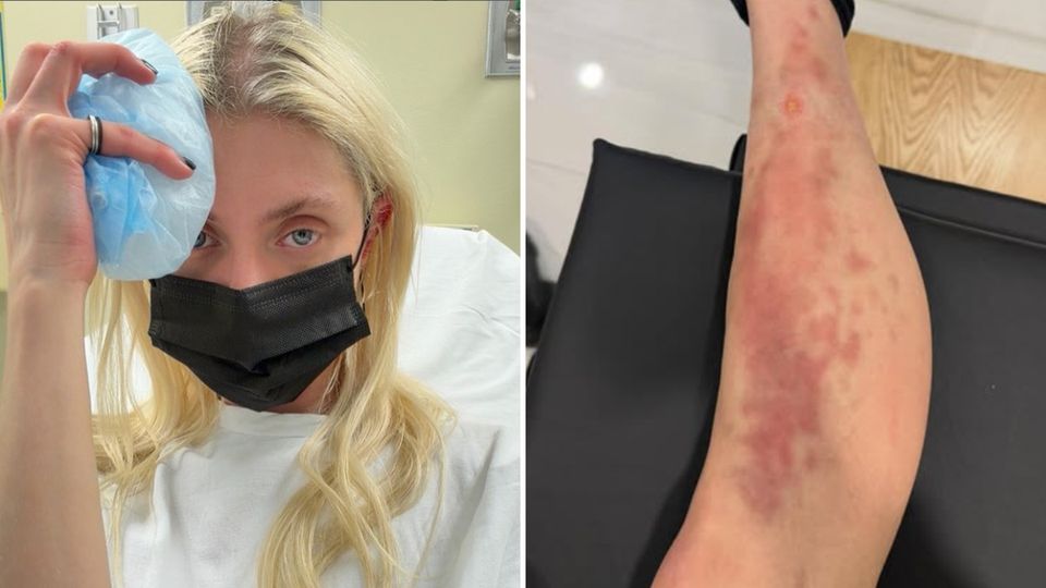 Taylor Momsen Hospitalised With Spider Bite - Photo Credit Taylor Momsen Instagram